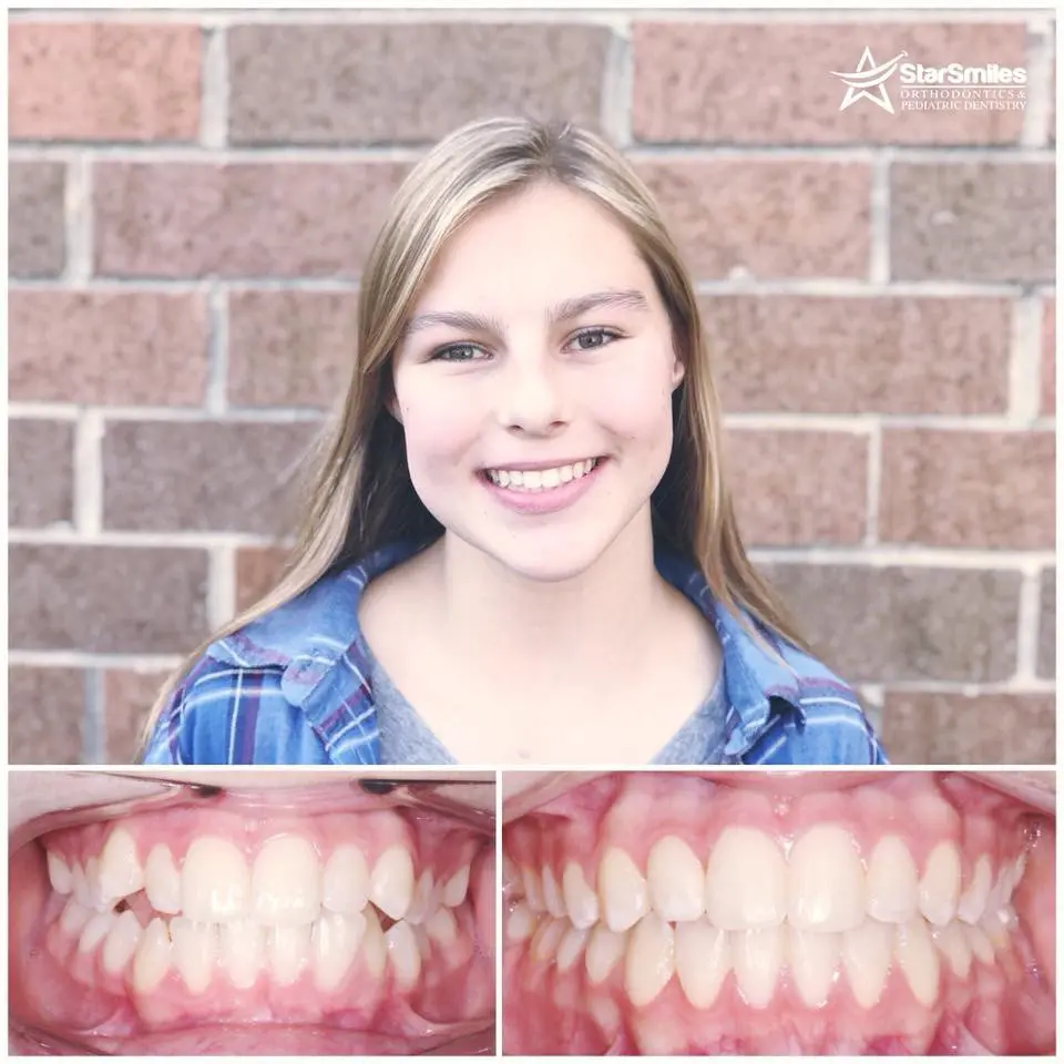At Star Smiles Orthodontics and Pediatric Dentistry in Naperville, IL. A close-up of teeth and gums before and after Invisalign treatment reveals a corrected bite and improved lower teeth alignment.