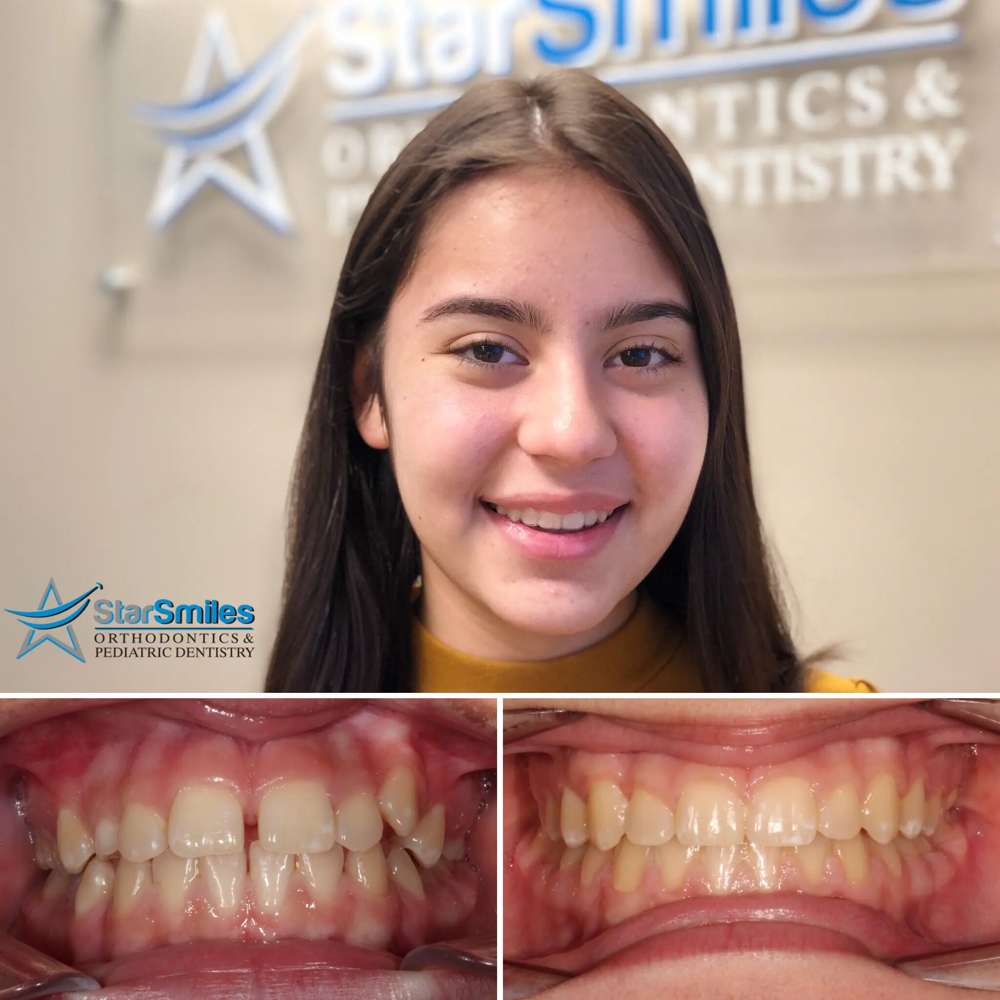 A side close-up of teeth and gums displays an overbite, with upper front teeth overlapping the lowers before and after Invisalign treatment at Star Smiles Orthodontics and Pediatric Dentistry in Bloomingdale, IL.