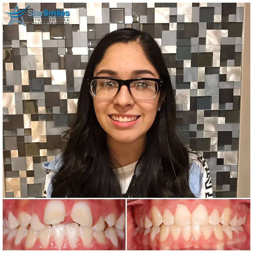 A side close-up of teeth and gums displays an overbite, with upper front teeth overlapping the lowers before and after Invisalign treatment at Star Smiles Orthodontics and Pediatric Dentistry Naperville, IL.