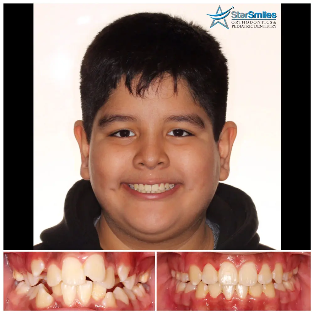 A side-by-side comparison of a person's teeth before and after dental braces work highlights the transformation from misaligned, discolored teeth to straightened, whitened results. By trusted orthodontist Star Smiles Orthodontics and Pediatric Dentistry in Naperville, IL.