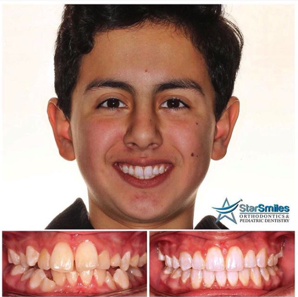 A side-by-side comparison of a person's teeth before and after dental braces work highlights the transformation from misaligned, discolored teeth to straightened, whitened results. By trusted orthodontist Star Smiles Orthodontics and Pediatric Dentistry in Bloomingdale, IL.