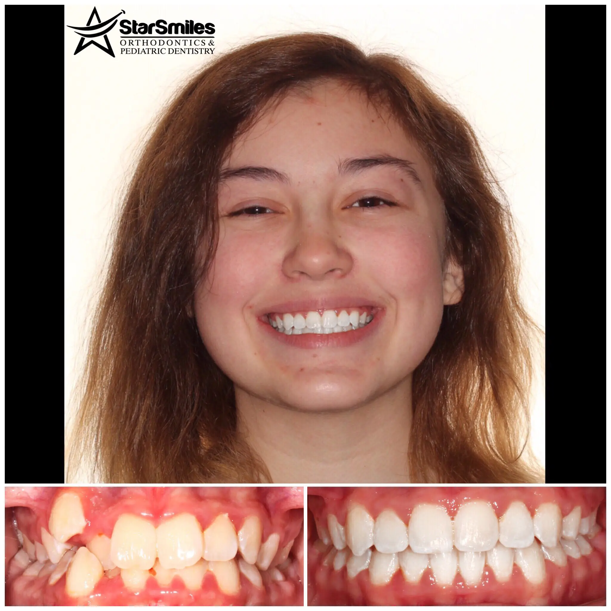 A side-by-side comparison of a person's teeth before and after dental braces work highlights the transformation from misaligned, discolored teeth to straightened, whitened results. Discover the impact of Star Smiles Orthodontics and Pediatric Dentistry for achieving your perfect smile in Naperville, IL.