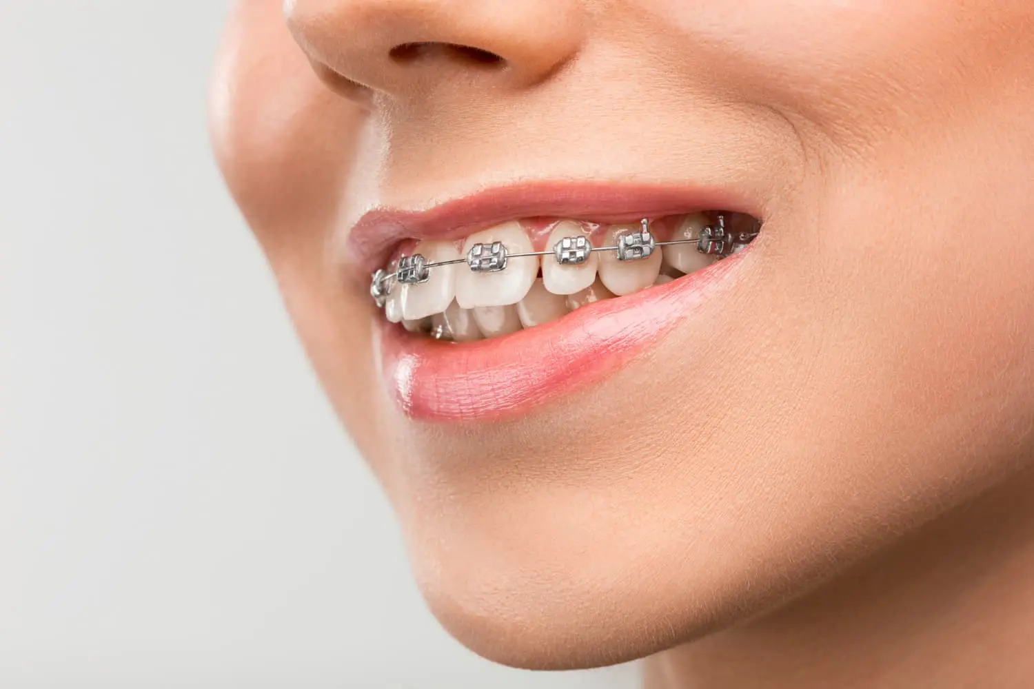 Woman smiling confidently while undergoing treatment for overbite at a trusted orthodontic clinic in Bloomingdale and Naperville, IL.