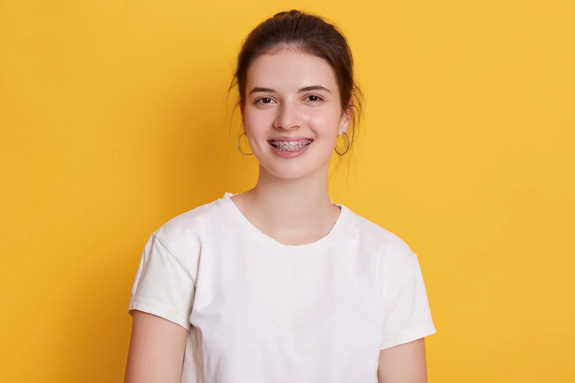 A Woman displays teeth with metal braces on both the upper and lower rows, crafted by a skilled orthodontist in Bloomingdale and Naperville, IL.