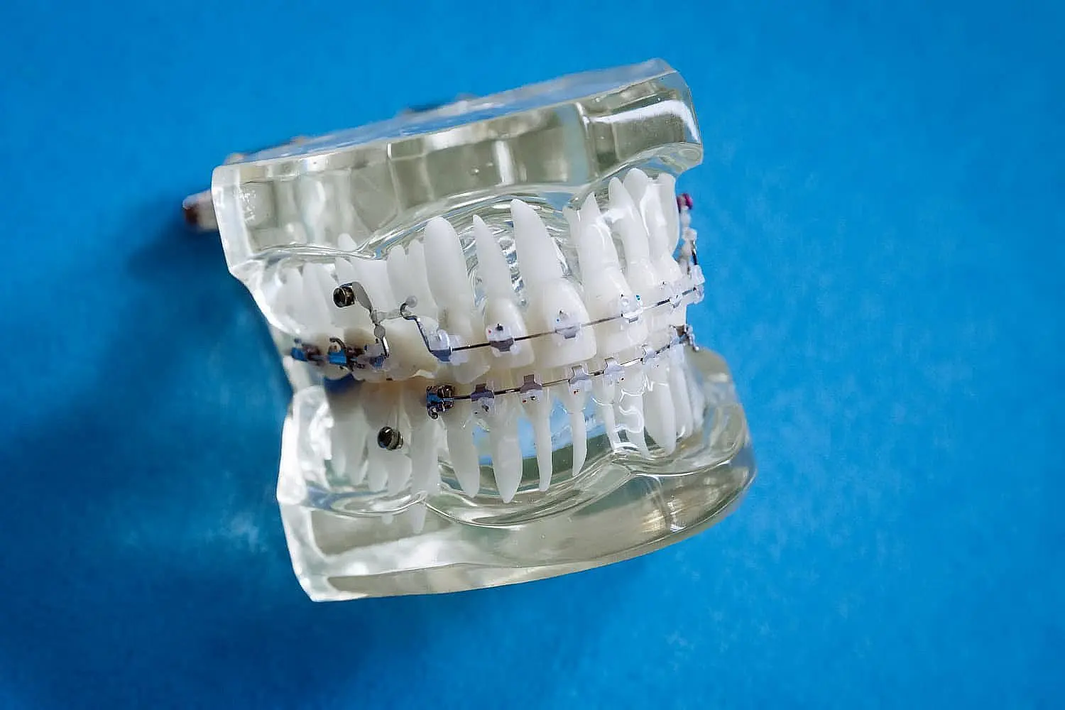 A dental model displays upper and lower teeth fitted with metal braces and wires against a blue background in Bloomingdale and Naperville, IL.