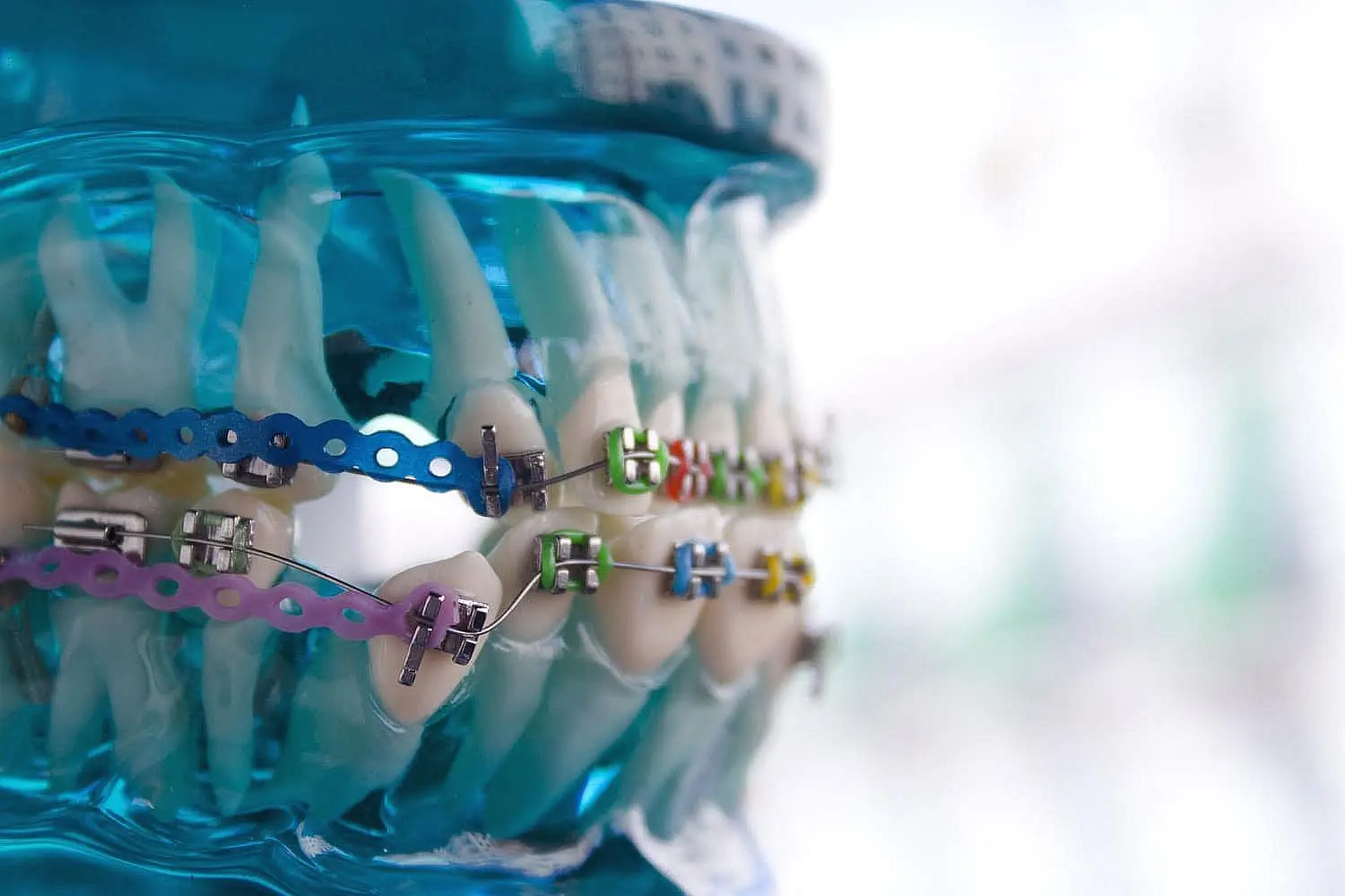 A dental model with metal braces, featuring colorful brackets and bands on artificial teeth, is displayed in the background at Star Smiles Orthodontics and Pediatric Dentistry in Bloomingdale and Naperville, IL.