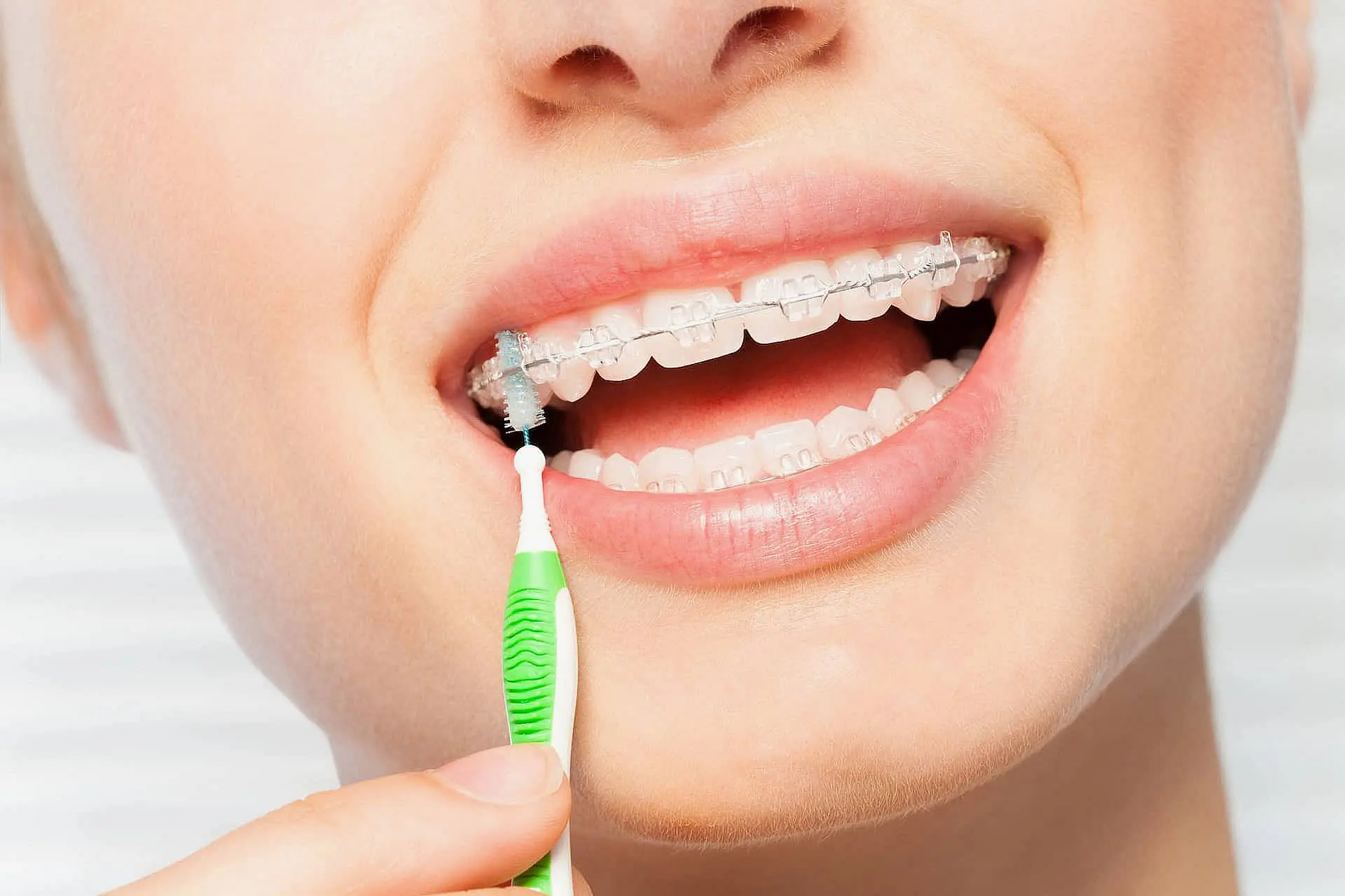 A person at Star Smiles Orthodontics and Pediatric Dentistry in Bloomingdale and Naperville, IL. Smiles while cleaning their clear braces with an interdental brush, showcasing healthy teeth and good dental hygiene.