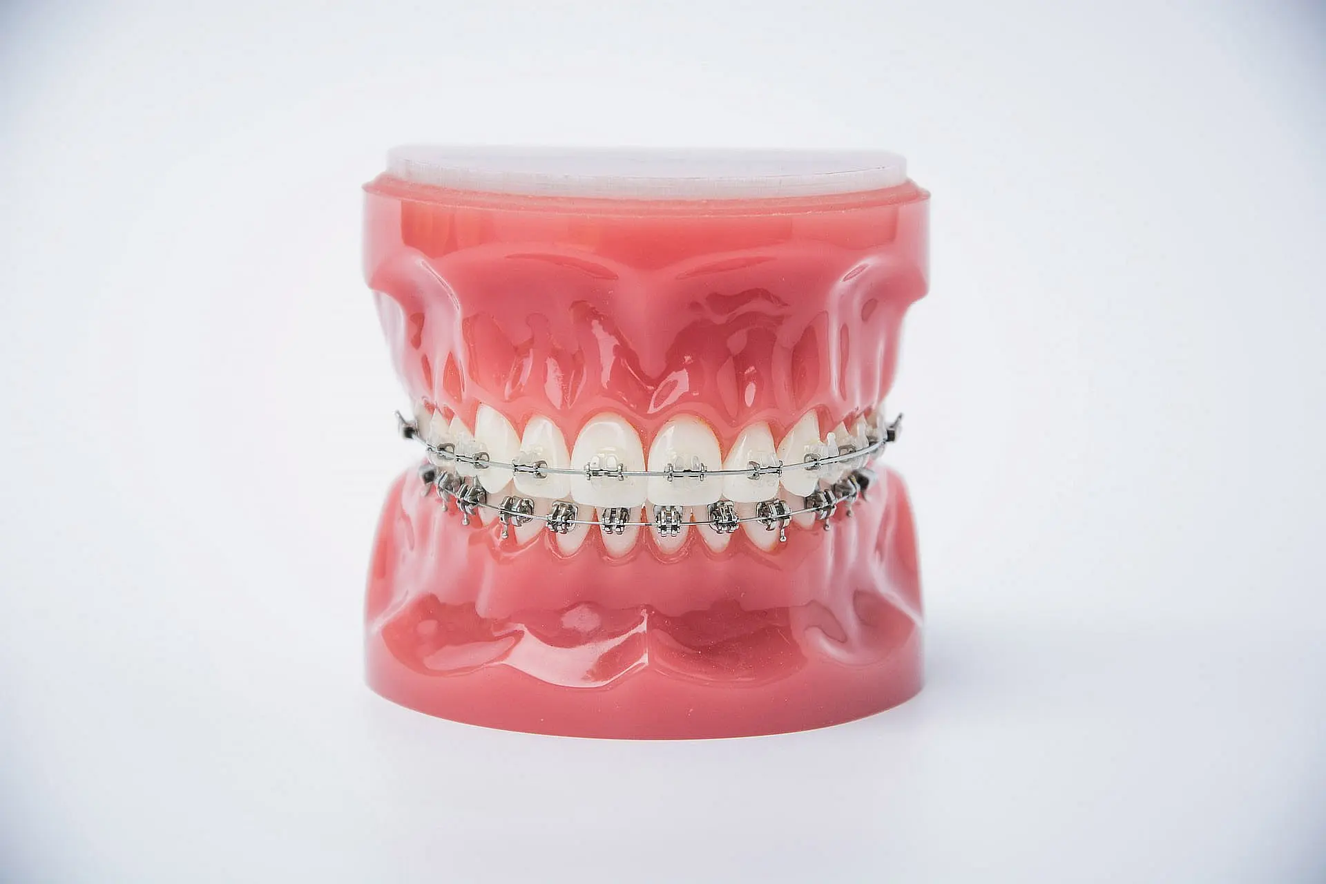 The dental model at Star Smiles Orthodontics and Pediatric Dentistry in Bloomingdale and Naperville, IL. Showcases upper and lower teeth with metal braces, clearly highlighting their structure and design.