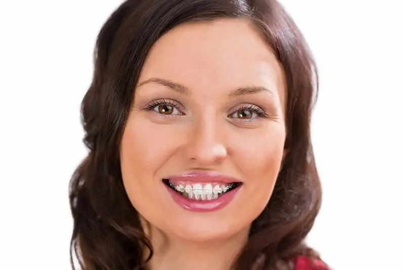 A woman smiling broadly, their teeth adorned with ceramic braces after treatment clear braces at Star Smiles Orthodontics and Pediatric Dentistry in Bloomingdale, IL.