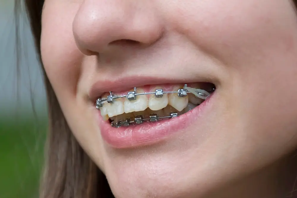 smiling girl metal braces her teeth - Invisalign vs Braces Cost in Bloomingdale and Naperville, IL. 