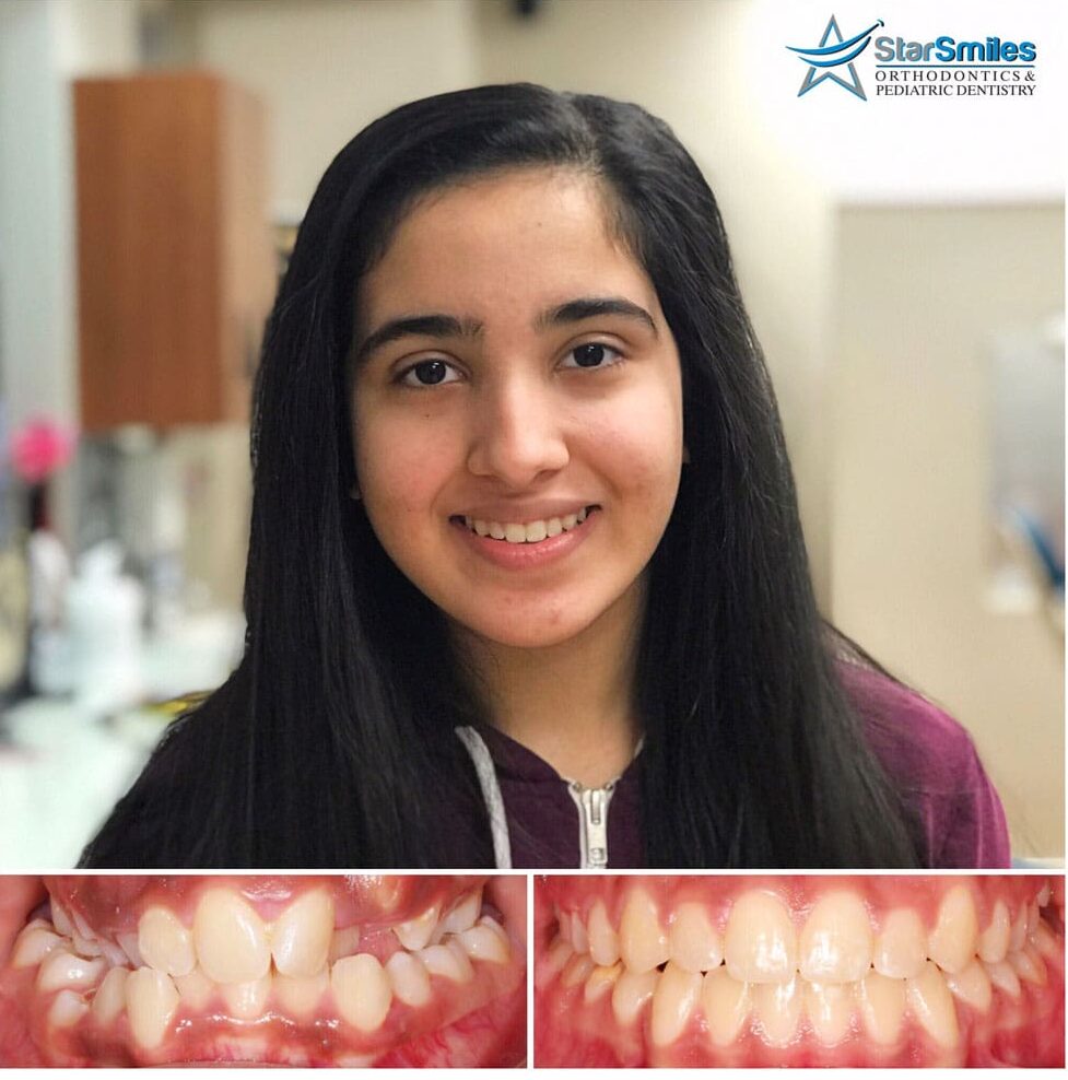 At Star Smiles Orthodontics and Pediatric Dentistry in Bloomingdale, IL. A close-up of teeth and gums before and after Invisalign treatment reveals a corrected bite and improved lower teeth alignment.